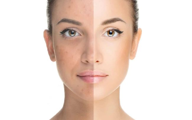 difference-between-an-anti-blemish-cream-and-a-brightener-1 تفاوت کرم ضد لک با روشن کننده