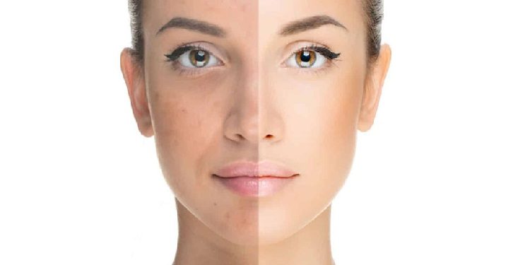 difference-between-an-anti-blemish-cream-and-a-brightener-1 تفاوت کرم ضد لک با روشن کننده