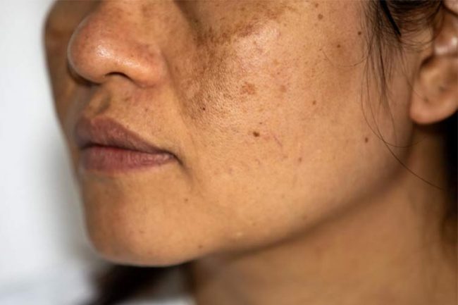 Deficiency-of-which-vitamin-causes-facial-spots کمبود کدام ویتامین باعث لک صورت میشود