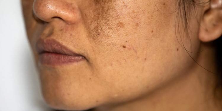 Deficiency-of-which-vitamin-causes-facial-spots کمبود کدام ویتامین باعث لک صورت میشود